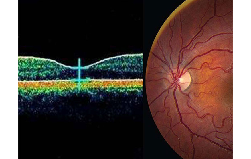 Galvanometro dell'analizzatore di Han nell'imaging oftalmico